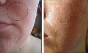 До и после лазерного пилинга: сравнение состояния кожи